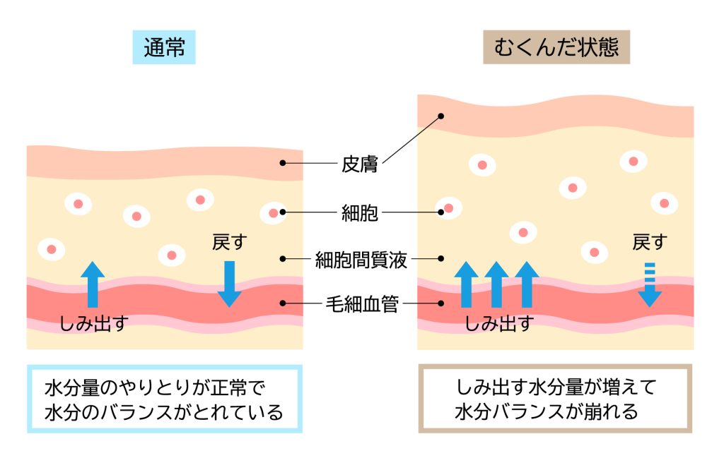 5. むくみのメカニズムを理解しよう