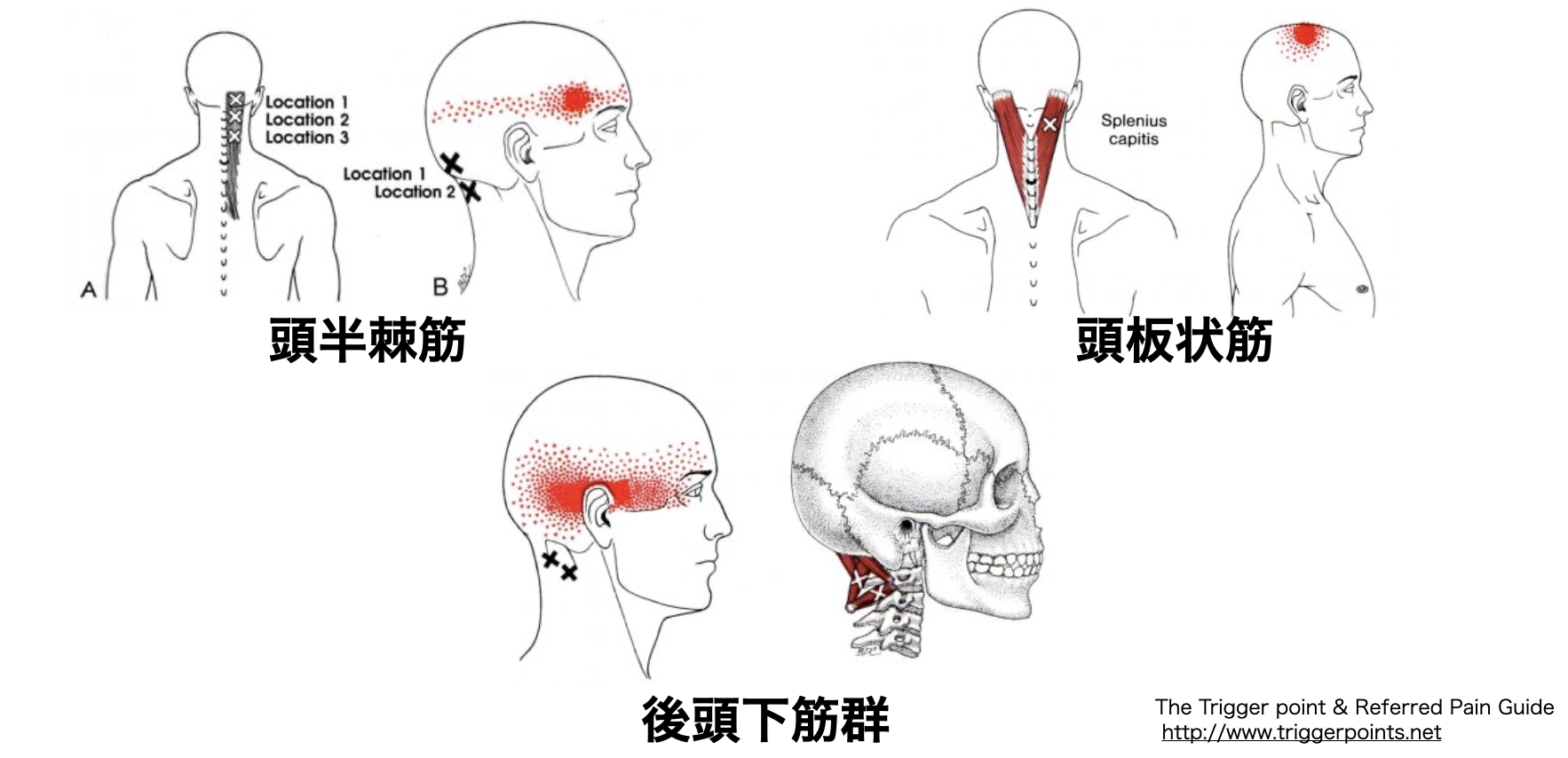 緊張型頭痛を理解する